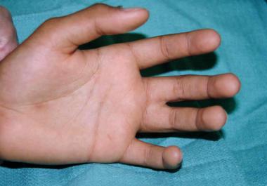 Palmar view of hand with syndactyly. The level of 