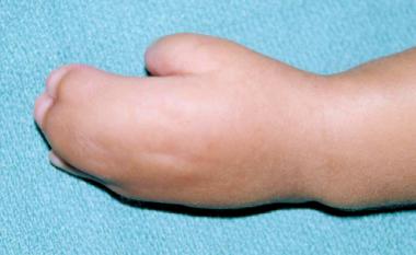 Dorsal view of hand of a 6-month-old patient with 