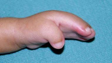 Radial view of hand of a 6-month-old patient with 
