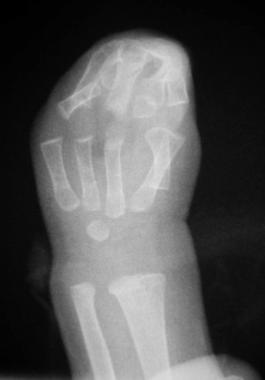 Radiograph of the left hand of a patient with Aper