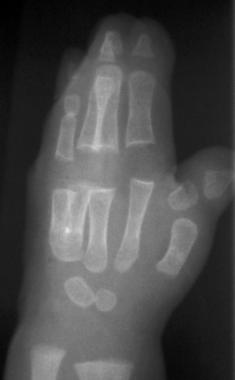 Radiograph of hand of the 6-month-old patient with