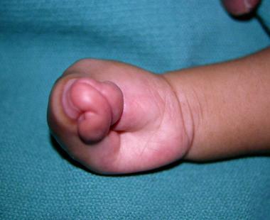 Apert syndrome (type III), volar view. 