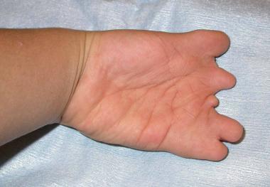 Volar view of the preceding hand in a patient affe