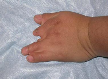 Poland Syndrome: Dorsal view of a left hand in a p