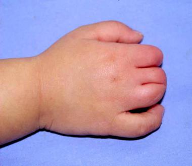 Dorsal view of the right hand of a 1.5-year-old pa