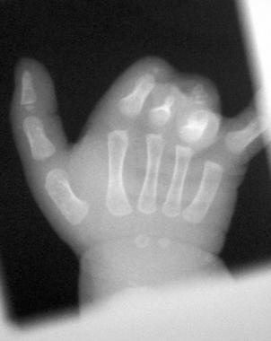 Right hand of a 1.5-year-old patient with constric