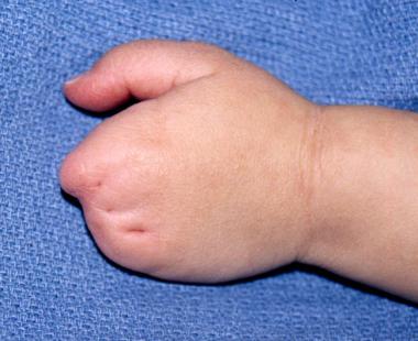 Dorsal view of left hand of a 1.5-year-old patient