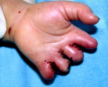 Image of the left hand of a 1.5-year-old patient w