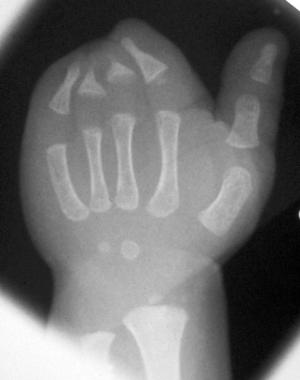Radiograph of left hand of a 1.5-year-old patient 