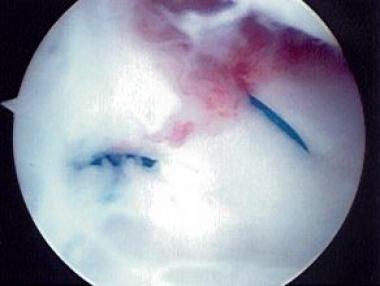 Sigmoid notch of distal radius with distinct dorsa