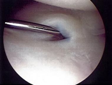 Palmer class 1A tear of triangular fibrocartilage 