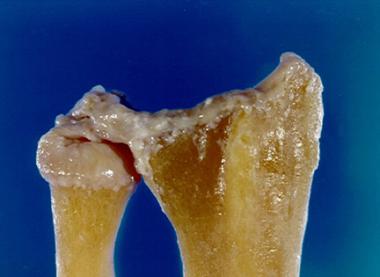 Relation of triangular fibrocartilage complex to d