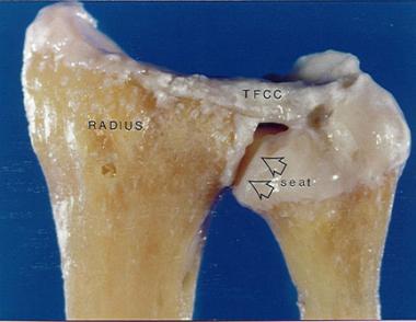 Seat of ulnar head articulates with sigmoid notch 