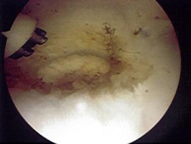 Ulnocarpal portion of triangular fibrocartilage co