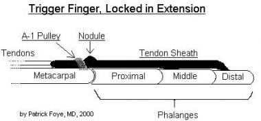 Inflamed nodule can restrict tendon from passing s