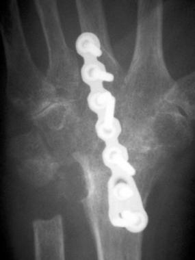 Posteroanterior radiograph of the wrist following 