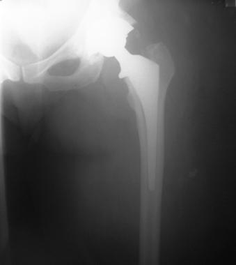 Acetabular wear in total hip arthroplasty. Cementl