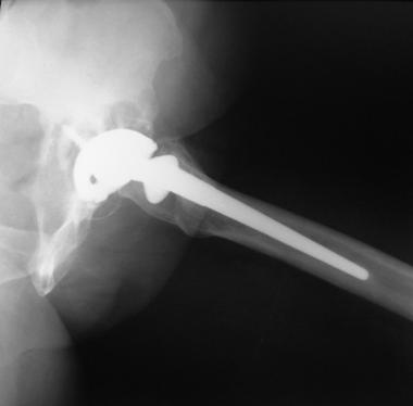 Acetabular wear in total hip arthroplasty. Lateral