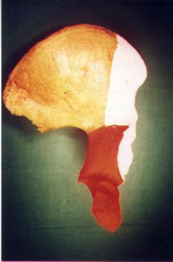 Columns of the acetabulum, iliac view. 