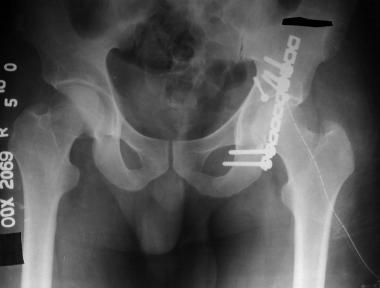 Posterior wall fracture: Postoperative anteroposte