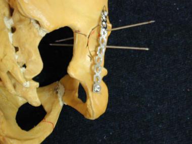 Fixation of posterior wall fracture: Bone model sh