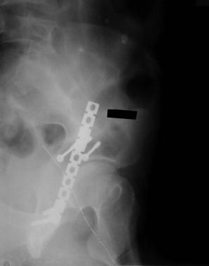 Posterior lip fracture: Postoperative iliac view. 