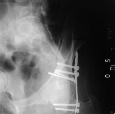 Posterior wall fracture: Postoperative obturator v