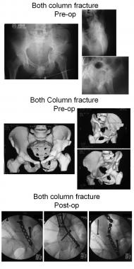 Both-column fracture. 