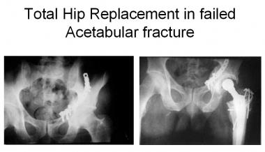 Total hip replacement in posttraumatic arthritis a