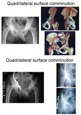 Quadrilateral surface comminution: Use of a T-plat