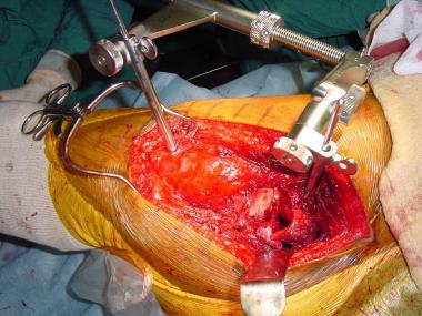 Use of femoral distractor during surgery. 