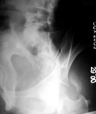 Posterior wall fracture preoperative obturator vie