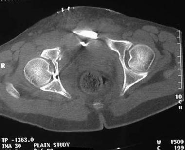 Intra-articular screw as seen on the axial cut of 