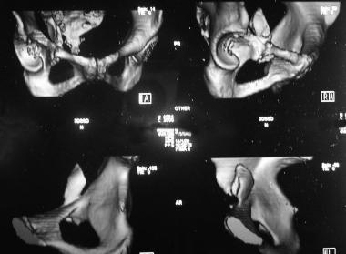 Anterior wall fracture: Three-dimensional reconstr