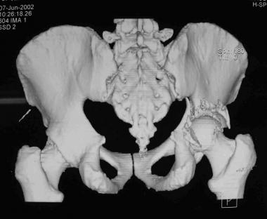 Posterior wall with posterior column fracture, 3-D