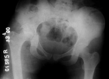 Transverse with posterior lip fracture. 