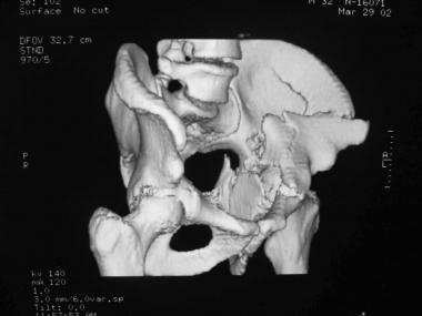 Both-column fracture, 3-D reconstruction, iliac vi