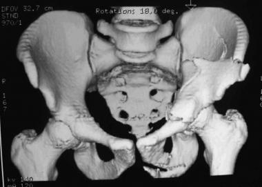 Both-column fracture, 3-D reconstruction, anteropo