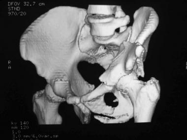 Both-column fracture, 3-D reconstruction, obturato