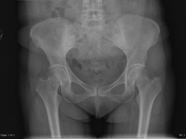 A normal anteroposterior (AP) pelvis radiograph. 