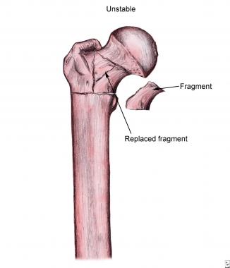 Unstable intertrochanteric fracture. 