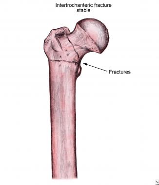 Stable intertrochanteric fracture. 