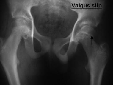 Valgus slip (rare). 