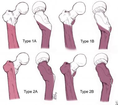 The Russell-Taylor classification of subtrochanter