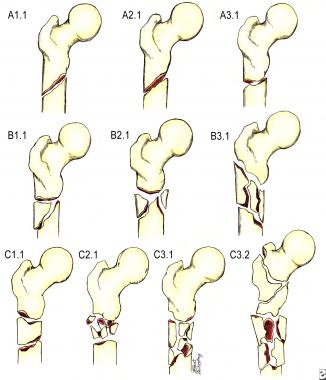 The Arbeitsgemeinschaft für osteosynthesefragen–As