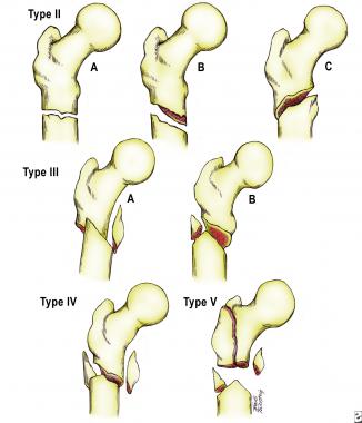 The Seinsheimer classification of subtrochanteric 