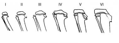 Diagram depicting the radiographic changes in the 