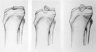 Meyers and McKeever classification of type I, II, 