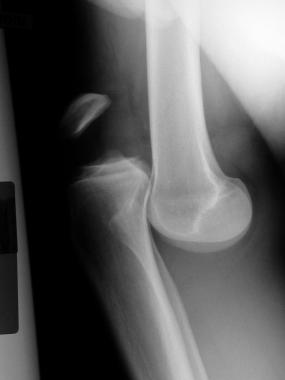 Knee dislocations. Lateral radiograph of anterior 