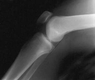 Lateral radiograph of a normal knee. In a normal k